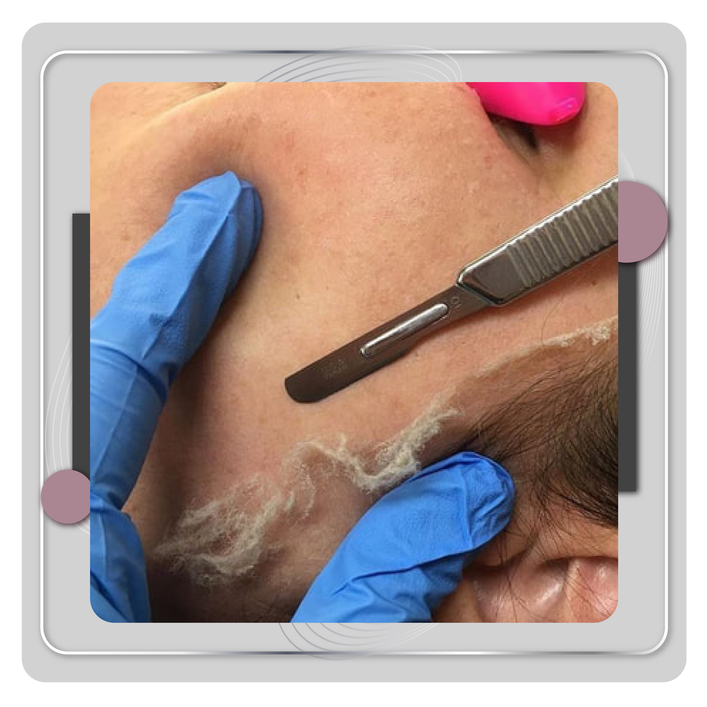 Dermaplaning